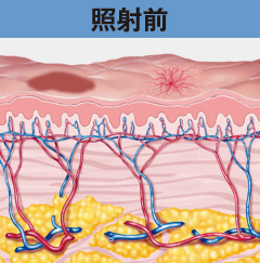 IPL照射前