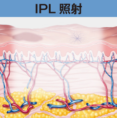 IPL照射