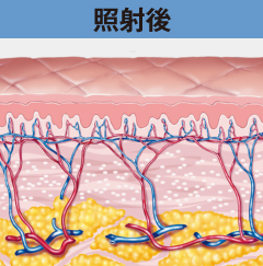 IPL照射後