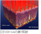 [2]1320-nmの第1照射