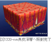 [3]1320-nm真皮深層へ照射完了