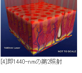 [4]即1440-nmの第2照射