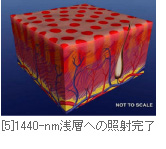 [5]1440-nm浅層への照射完了