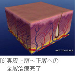 [6]真皮上層～下層への全層治療完了