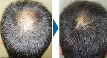 Dr.CYJヘアーフィラー | 薄毛治療・毛髪再生医療[男性の脱毛症] | 診療 