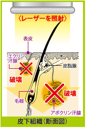 レーザー治療